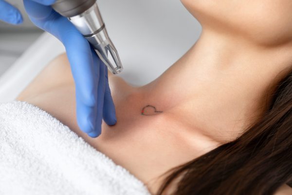 Doctor,Beautician,Makes,Laser,Tattoo,Removal,On,The,Neck,Of